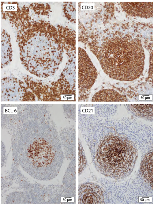 Germinal centre histology. Representative immunohistochemistry of germinal centres within an MSLN draining an inflamed region of the bowel during an acute flare of CD requiring surgical resection using CD3 (T cells), CD20 (B cells), BCL6 (GC B cells (or T